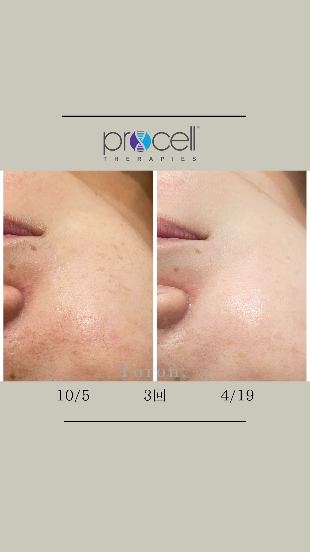 procellフェイシャル | Toron.